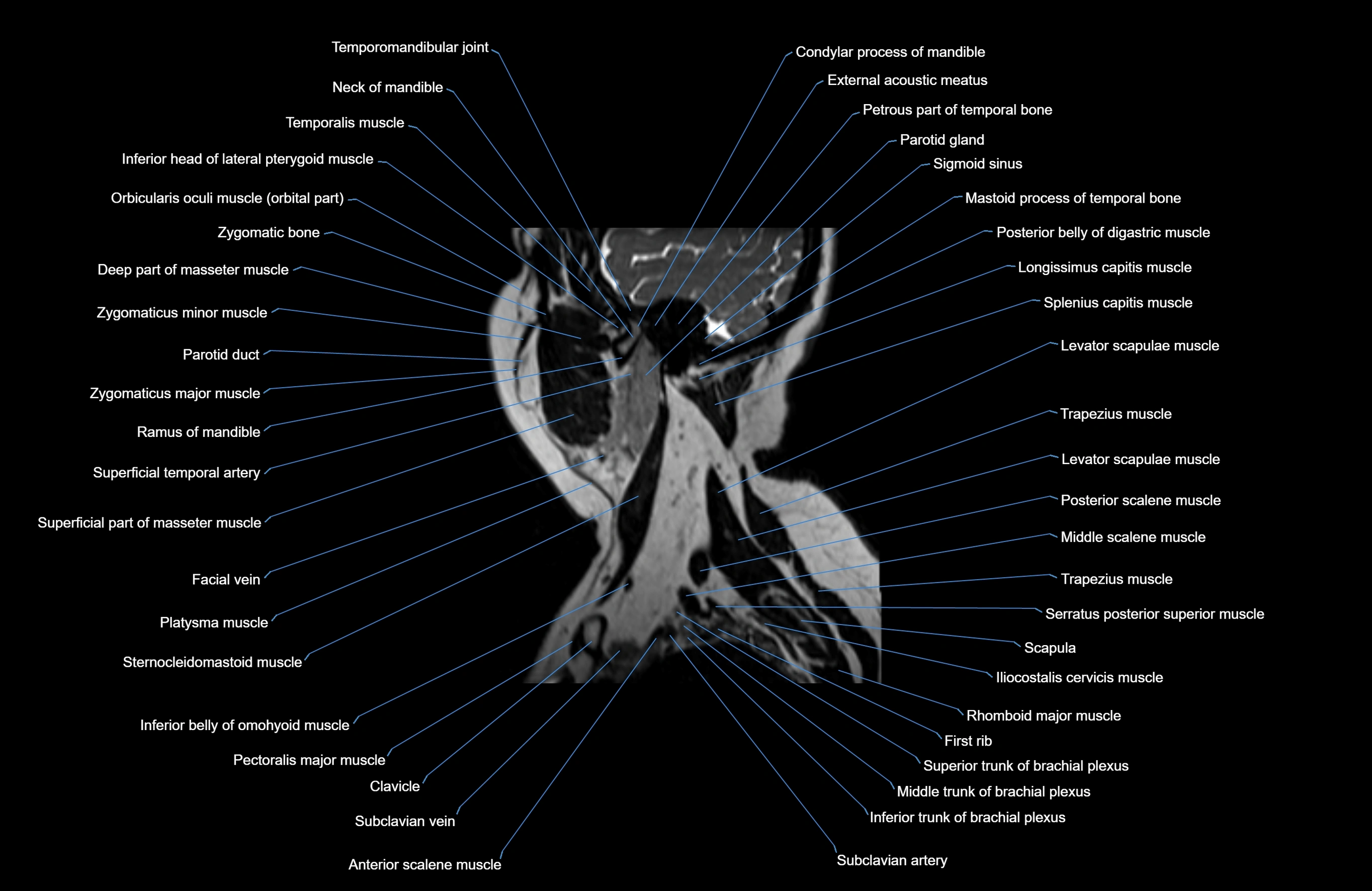 Neck MRI sagittal cross sectional anatomy 3D 1mm 3T radiology  image-img-00001-00031.webp